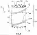 Fig. 02 - Transcatheter prosthesis with sealing component, and systems and methods for delivering and deployment thereof