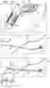 Fig. 04 - POST-IMPLANTATION TENSIONING IN CARDIAC IMPLANTS