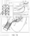 Fig. 05 - POST-IMPLANTATION TENSIONING IN CARDIAC IMPLANTS
