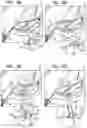 Fig. 06 - POST-IMPLANTATION TENSIONING IN CARDIAC IMPLANTS