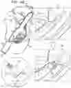 Fig. 08 - POST-IMPLANTATION TENSIONING IN CARDIAC IMPLANTS