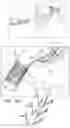 Fig. 13 - POST-IMPLANTATION TENSIONING IN CARDIAC IMPLANTS