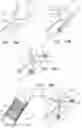 Fig. 22 - POST-IMPLANTATION TENSIONING IN CARDIAC IMPLANTS