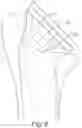 Fig. 09 - Shoulder arthroplasty implant system