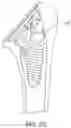 Fig. 32 - Shoulder arthroplasty implant system