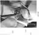 Fig. 44 - Shoulder arthroplasty implant system