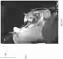 Fig. 48 - Shoulder arthroplasty implant system