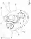 Fig. 14 - Augment insert, shoulder prosthesis and kit comprising the augment insert