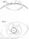 Fig. 04 - Ring used in a small pupil phacoemulsification procedure