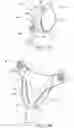 Fig. 20 - Absorbent article, enclosing pants, and method for wearing combination thereof