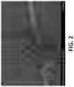 Fig. 03 - PREVENTION OF URINARY TRACT DEVICE ENCRUSTATION