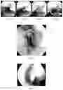 Fig. 10 - Implantable scaffolds for treatment of sinusitis and method of reducing inflammation