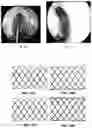 Fig. 11 - Implantable scaffolds for treatment of sinusitis and method of reducing inflammation
