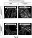 Fig. 09 - Three-dimensional bioprinting of cardiac patch with anisotropic and perfusable architecture