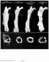 Fig. 12 - Growth factor transduced cell-loaded ceramic scaffold for bone regeneration and repair
