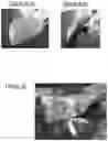 Fig. 09 - HAEMOSTATIC DEVICE
