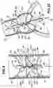 Fig. 07 - Method and apparatus for long-term assisting a left ventricle to pump blood