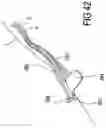Fig. 25 - Intravenous Catheter Insertion And Blood Sample Devices And Method Of Use