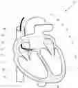 Fig. 01 - Single conduit multi-electrode cardiac pacemaker