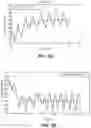 Fig. 03 - Methods and systems for lowering blood pressure through reduction of ventricle filling