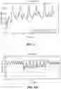 Fig. 04 - Methods and systems for lowering blood pressure through reduction of ventricle filling