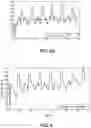 Fig. 05 - Methods and systems for lowering blood pressure through reduction of ventricle filling