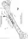 Fig. 02 - Electrical Stimulation Screws