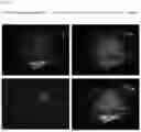 Fig. 11 - COMPOSITIONS AND METHODS FOR DETECTING AND TREATING PATHOLOGICAL FIBROBLAST CELLS