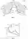 Fig. 04 - Systems and methods for shearing adjustment of a dental aligner cutting tool