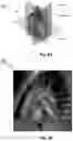 Fig. 03 - Autonomous segmentation of contrast filled coronary artery vessels on computed tomography images