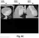 Fig. 09 - Autonomous segmentation of contrast filled coronary artery vessels on computed tomography images