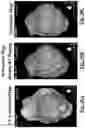 Fig. 37 - Device, system and use of a catheter system to record and map cardiac rhythm