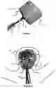 Fig. 02 - Devices for vascular occlusion