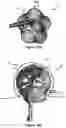 Fig. 08 - Devices for vascular occlusion