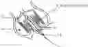 Fig. 01 - Remodeling of calcified aortic valve leaflets