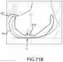 Fig. 158 - System and method for image segmentation, bone model generation and modification, and surgical planning