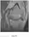 Fig. 22 - System and method for image segmentation, bone model generation and modification, and surgical planning