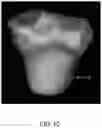 Fig. 32 - System and method for image segmentation, bone model generation and modification, and surgical planning