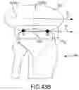 Fig. 87 - System and method for image segmentation, bone model generation and modification, and surgical planning