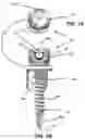 Fig. 02 - Dual tether support of vertebra