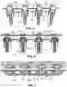 Fig. 05 - Dual tether support of vertebra
