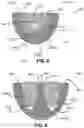 Fig. 06 - Dual tether support of vertebra