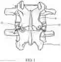 Fig. 02 - Sleeve for bone fixation device