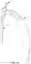 Fig. 45 - Hip or shoulder prosthesis and placement instruments