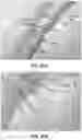 Fig. 43 - Methods, apparatuses, and systems for the treatment of pulmonary disorders
