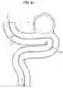 Fig. 04 - Method for determining the positioning in deployed position of an implantable medical device after expansion in a vascular structure