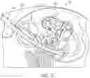 Fig. 05 - Cochlear implant localization system