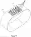 Fig. 08 - Abdominal closure method and device variations for closing ventral hernias and reducing recurrence