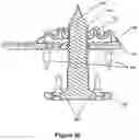 Fig. 28 - Abdominal closure method and device variations for closing ventral hernias and reducing recurrence