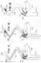 Fig. 04 - Floating carotid filter